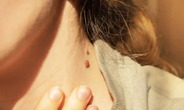 Body full of warts? Eliminate at home