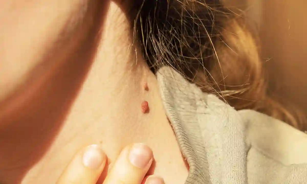 Body full of warts? Eliminate at home