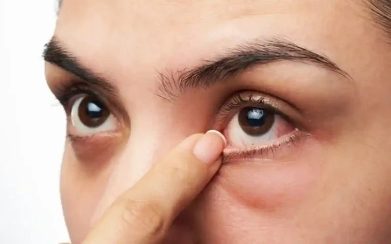 চোখের পাতা লাফানো: কারণ ও প্রতিকার