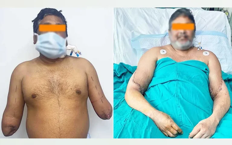 The painter regained a new life with the two hands given by the woman