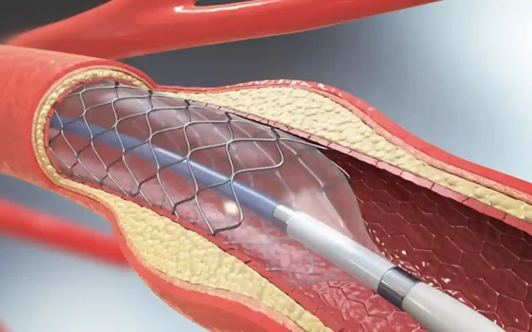 Cardiac stents