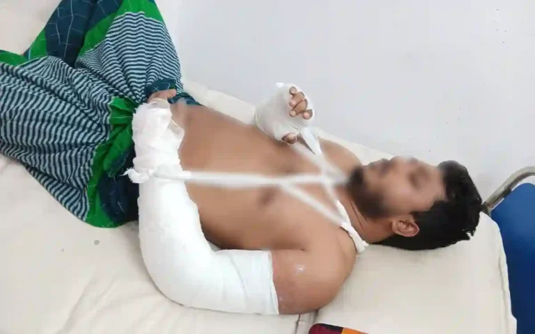 A gang of teenagers broke two hands of a teacher for protesting against eve-teasing