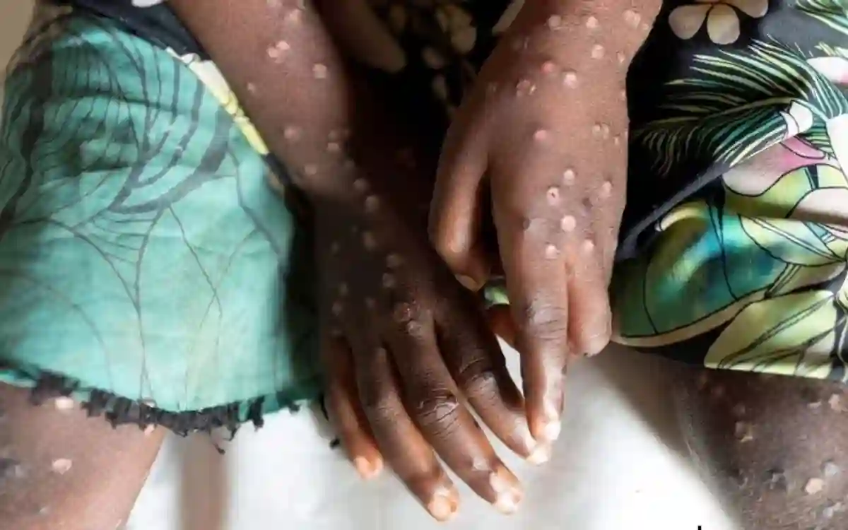 RisingCumilla.Com - Mpox (monkeypox)