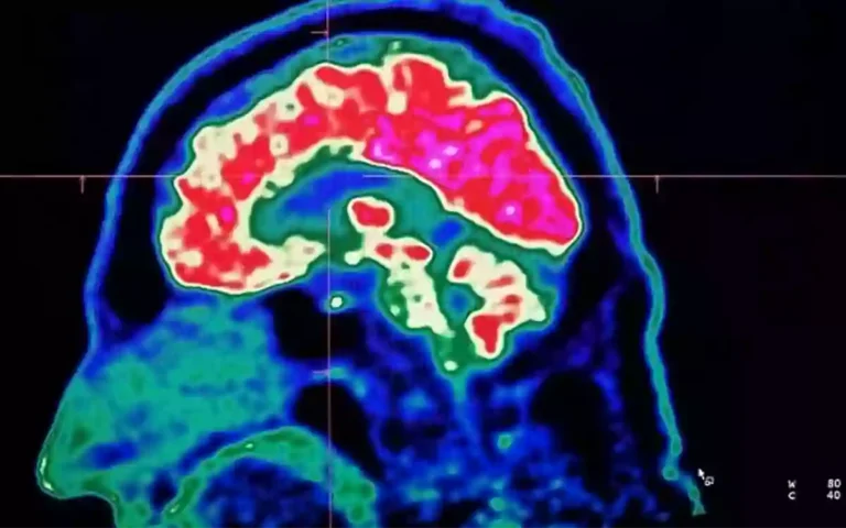 Rising Cumilla - Brain-eating Amoeba