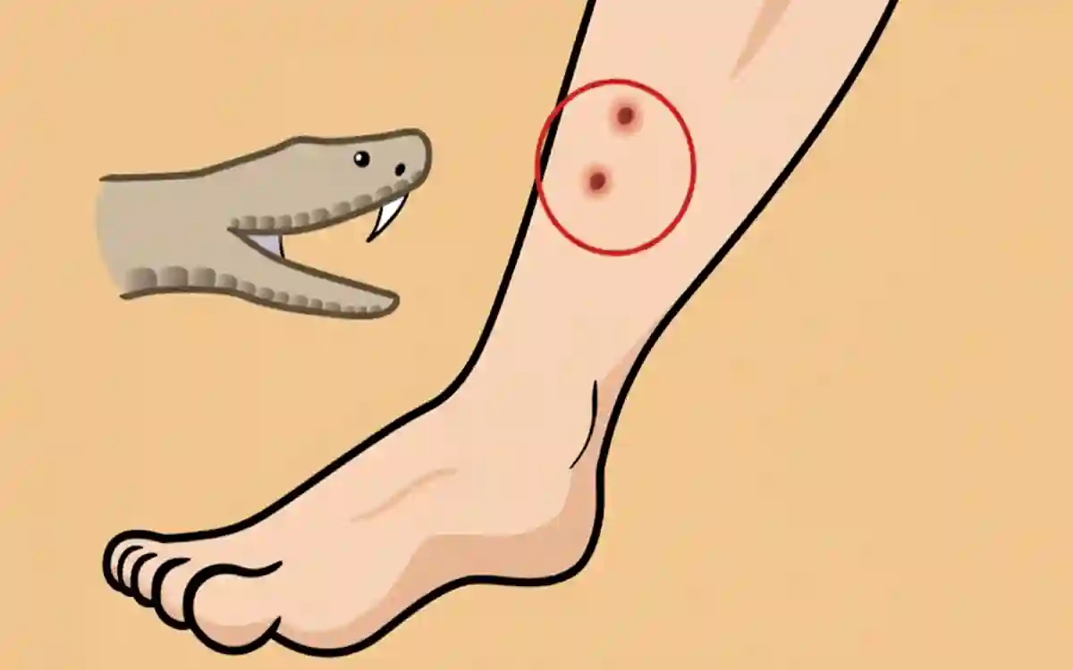 Rising Cumilla -Snake bite