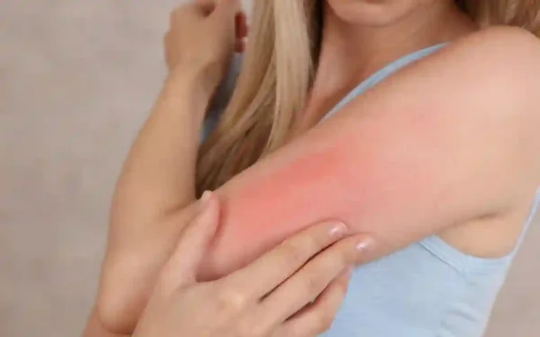 Rising Cumilla -allergy