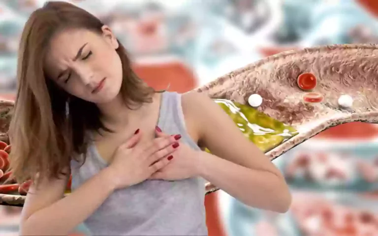 Rising Cumilla - High Cholesterol in Women