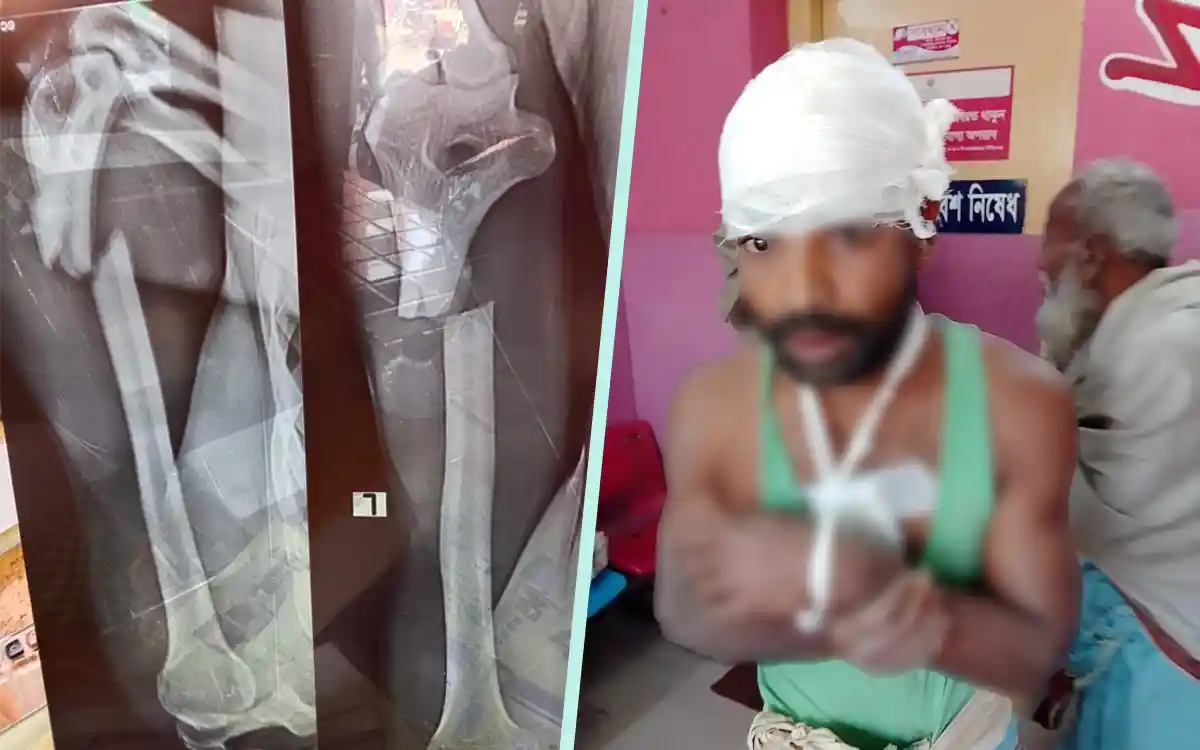 Rising Cumilla - Farmer's hand broken, slashed in Noakhali