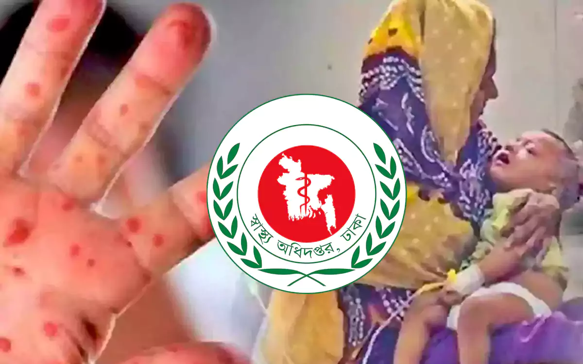 Rising Cumilla -measles patients - Directorate General of Health's